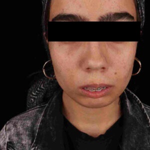 جراحی ارتوسرجری میترا سلطانی در کلینیک دکتر شهاب عزیزی