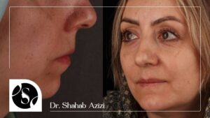 تغییرات چهره خانم قیاسی مراجعه کننده عمل جراحی زیبایی فک در کلینیک دکتر شهاب الدین عزیزی