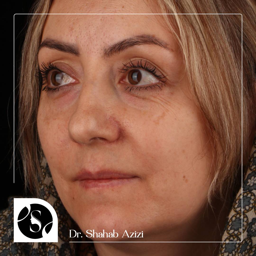جراحی زیبایی فک خانم قیاسی در کلینیک دکتر شهاب الدین عزیزی