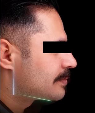 تصویر بعد از جراحی بایمکس توسط دکتر عزیزی