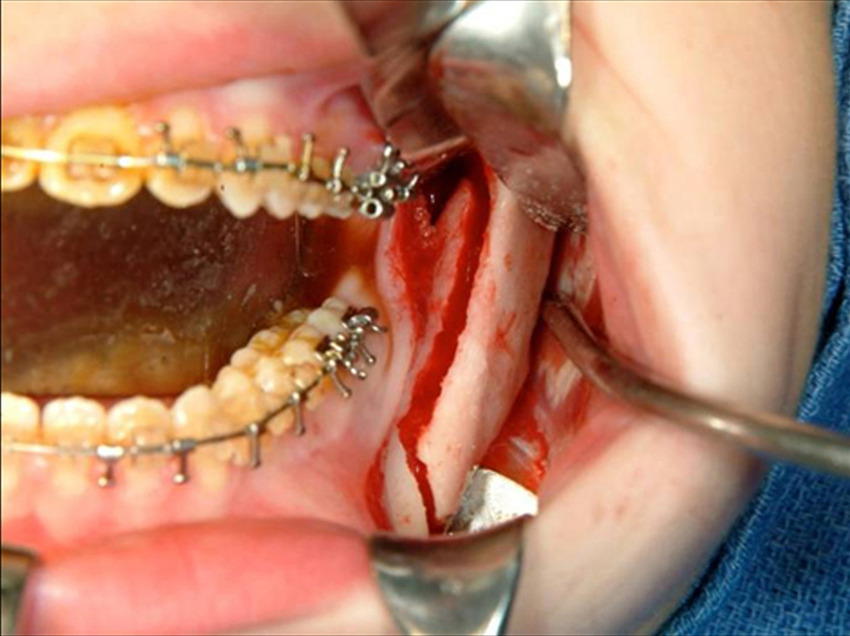 جراحی استئوتومی فک توسط دکتر شهاب الدین عزیزی