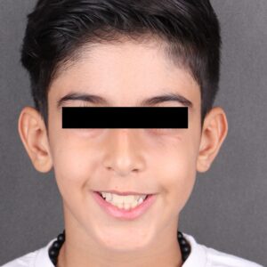 تصویر بعد از جراحی ترمیم صورت و گونه 