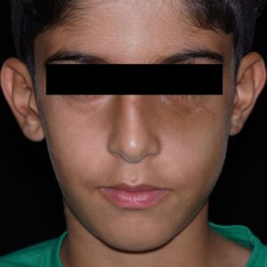 نمونه عکس قبل از جراحی و ترمیم گونه توسط دکتر شهاب الدین عزیزی