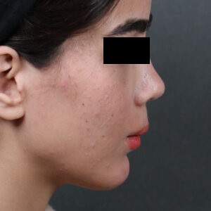 نمونه بعد از عمل فک پایین