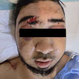 نمونه جراحی فک تروما یا ضربه ناشی از تصادف قبل از عمل