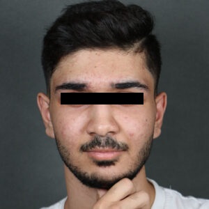 تصویر بعد از جراحی آسیب صورت و فک