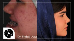 نمونه عمل جراحی فک بالا و پایین خانم شریف در کلینیک دکتر عزیزی