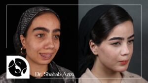 قبل و بعد از جراحی فک میترا سلطانی توسط دکتر شهاب الدین عزیزی