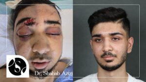 تجربیات محمدرضا مافی از جراحی فک و گونه توسط دکتر شهاب عزیزی