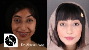 نمونه جراحی فک و تغییرات صورت بعد از عمل فک دیبا مرادخانی
