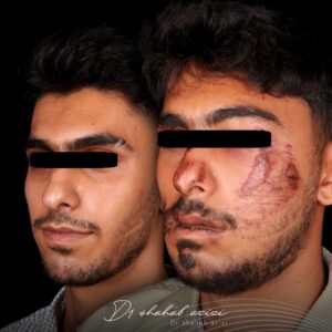 عکس قبل و بعد از عمل فک تروما یا ناشی از ضربه یا تصادف
