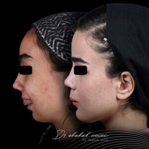 عکس قبل و بعد جراحی فک لبخند لثه ای