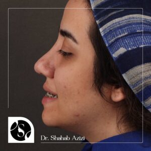 نمونه قبل و بعد عمل جراحی فک توسط دکتر شهاب الدین عزیزی