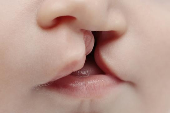 جراحی پیوند استخوان شکاف کام و لب