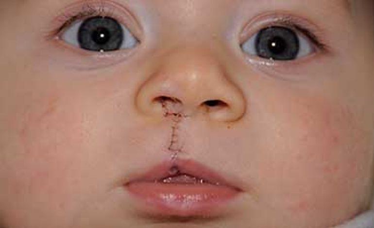 دکتر شهاب الدین عزیزی جراح شکاف کام و لب