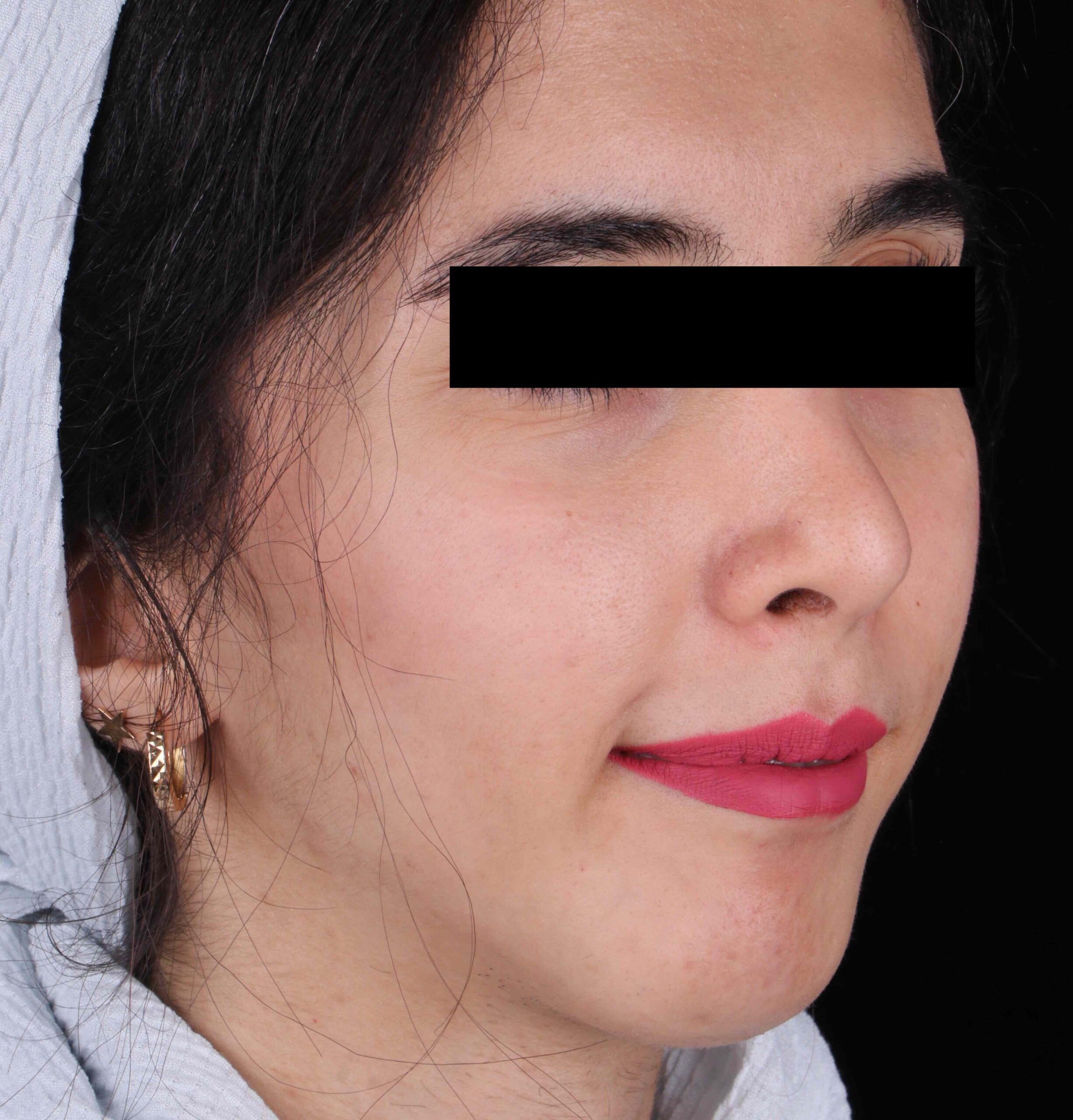 تغییرات بعد از جراحی چانه