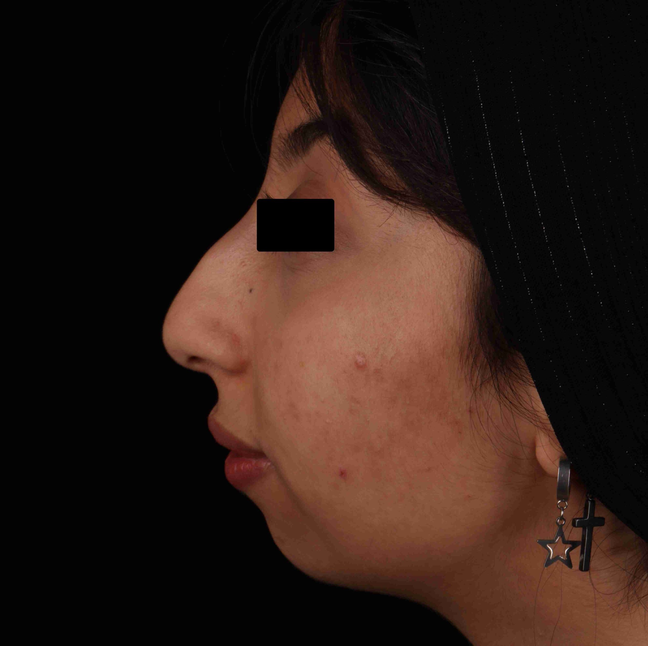 عکس پیش از عمل جراحی چانه