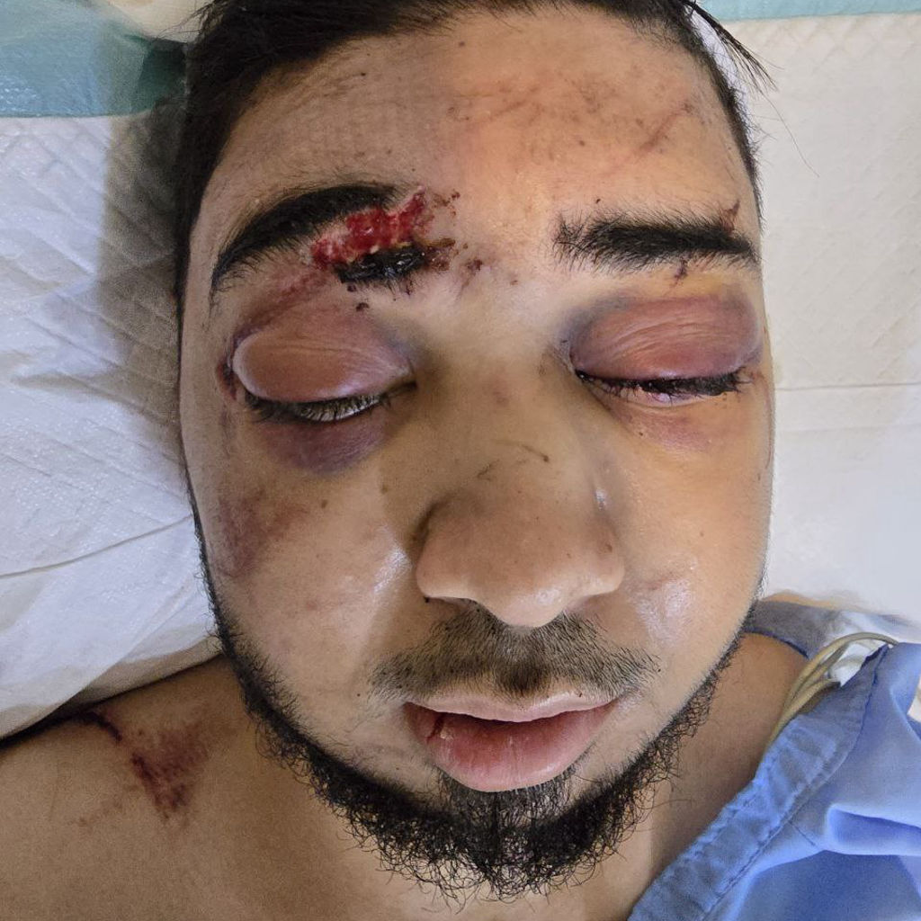 تصویر پیش از عمل محمدرضا مافی مراجعه کننده درمان تروما فک و صورت