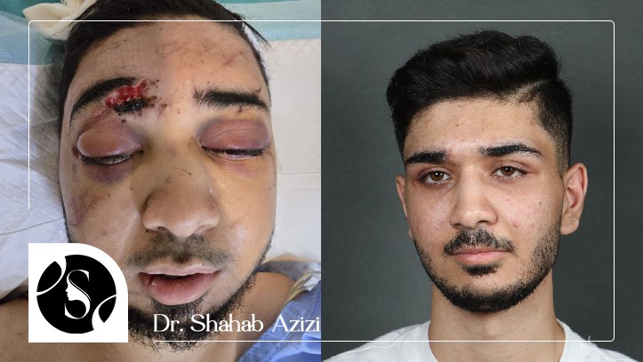 عمل جراحی شکستگی فک و صورت محمدرضا مافی
