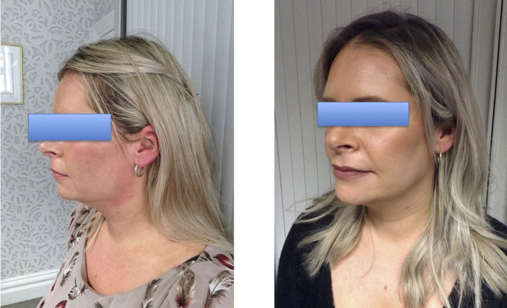 جراحی جنیوپلاستی توسط دکتر شهاب الدین عزیزی