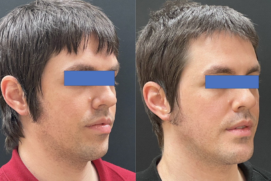 عمل جنیوپلاستی