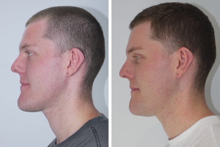 جراحی چانه در کلینیک دکتر شهاب الدین عزیزی