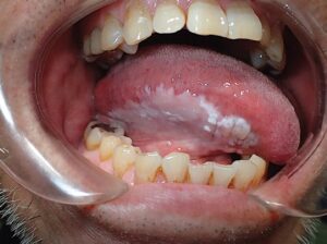 عفونت ناحیه فک، دهان و صورت