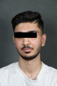 مراجعه کننده جراحی فک تروما (ناشی از ضربه و تصادف)