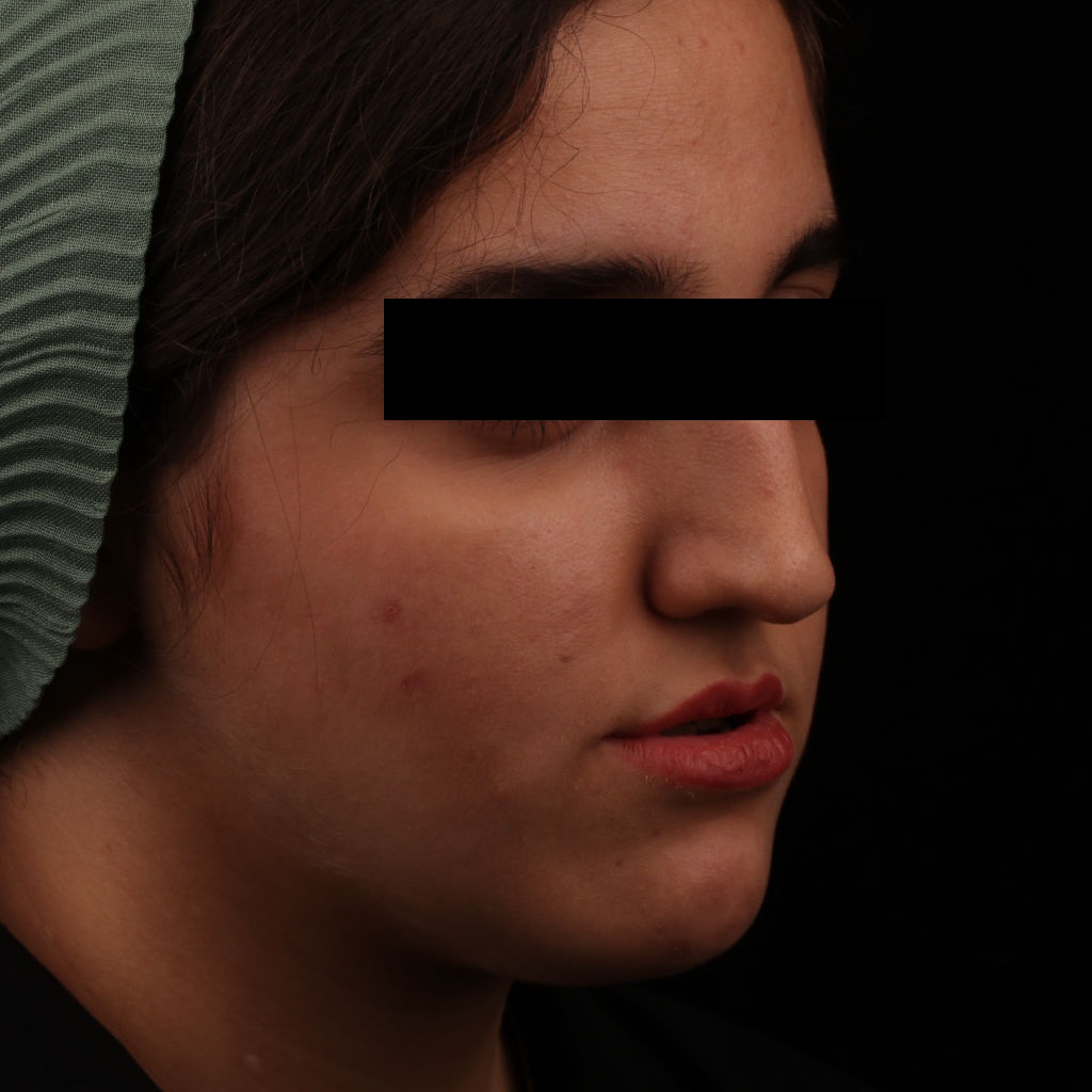 تصویر قبل از جراحی فک در کلینیک دکتر شهاب الدین عزیزی