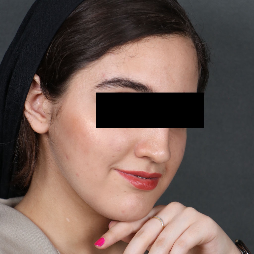 تصویر بعد از عمل جراحی فک توسط دکتر شهاب الدین عزیزی