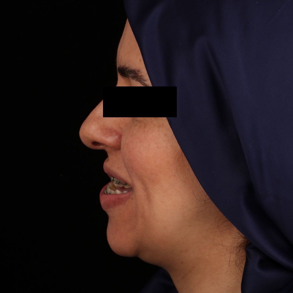 تصویر قبل از عمل جراحی فک توسط دکتر عزیزی