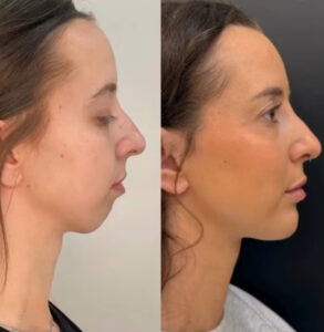 برای درمان عقب رفتگی فک پایین جنیوپلاستی انجام دهیم یا جراحی فک؟