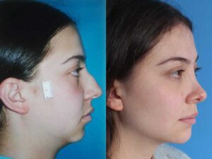 جراحی ترکیبی فک و چانه همزمان ممکن است؟