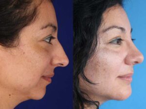 اصلی ترین تفاوت جراحی فک و عمل چانه