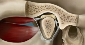 نشانه های عارضه مفصل گیجگاهی فکی یا TMJ