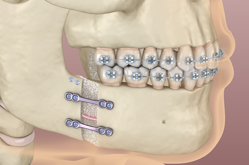 علت و تشخیص شل شدن پیچ فک بعد از عمل جراحی