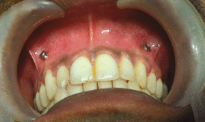 درمان مشکل شل شدن پیچ فک بعد از عمل