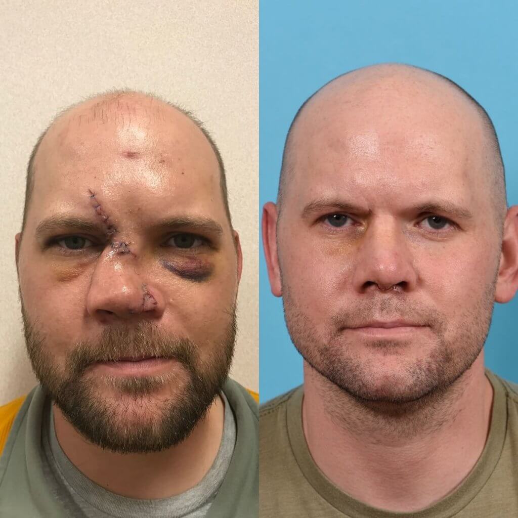 جراحی بازسازی پیشانی با پروتز شخصی سازی شده