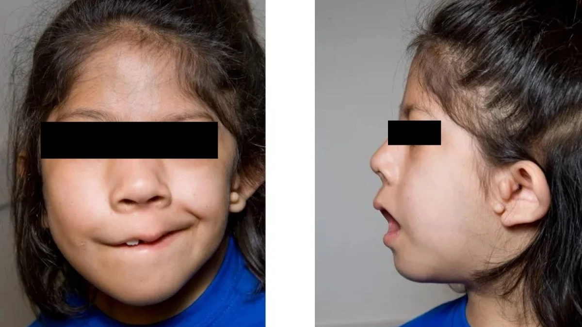 جراحی همی فیشیال میکروزومیا در کودکان