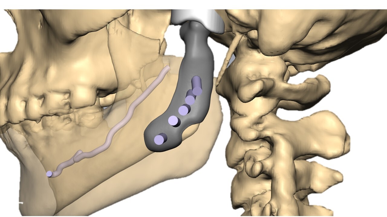 پروتز برای تعویض مفصل در شکستگی دو طرفه مفصل فک