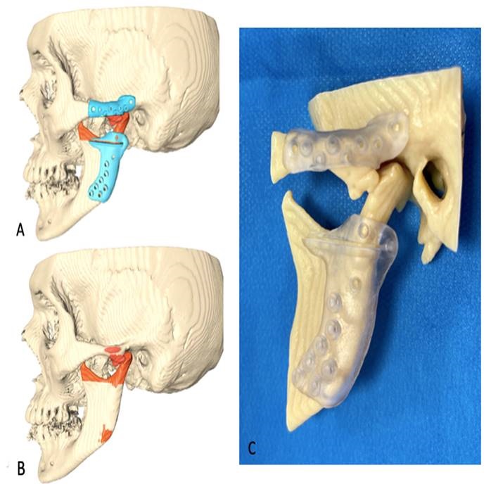 پروتز برای جایگزاری به جای مفصل در شکستگی دو طرفه مفصل فک