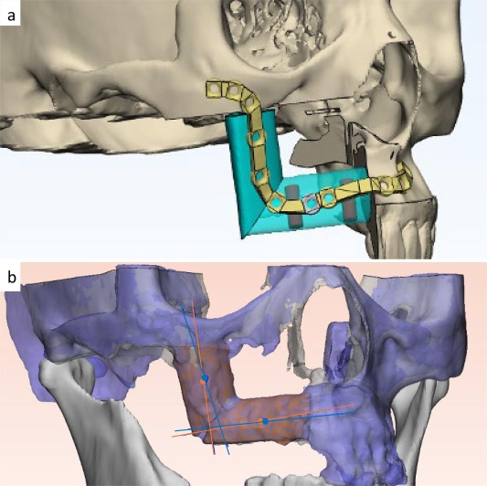 پیوند میکرووسکولار در فک توسط دکتر شهاب الدین عزیزی