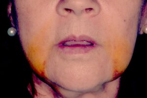 عفونت بعد از عمل جراحی فک را چطور درمان کنیم؟