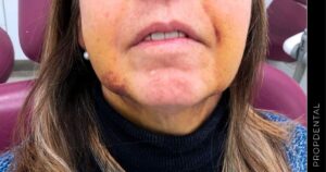 نشانه های مستقیم عفونت عمل فک چگونه ظاهر میشوند؟