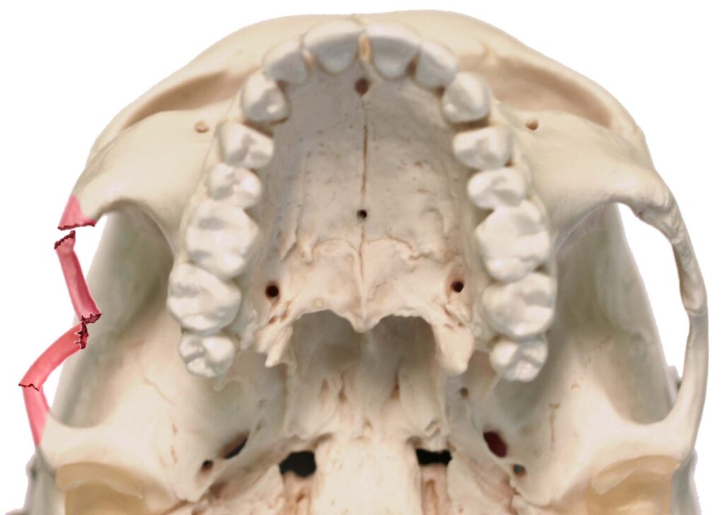 عمل شکستگی ماگزیلا