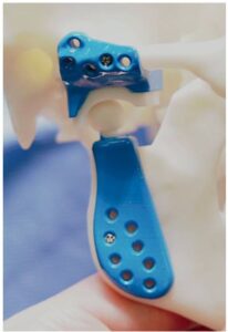 استفاده از پروتز آماده در شکستگی دوطرفه مفصل فک