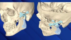 استفاده از ایمپلنت پیش ساخته در آسیب دو طرفه مفصل فک