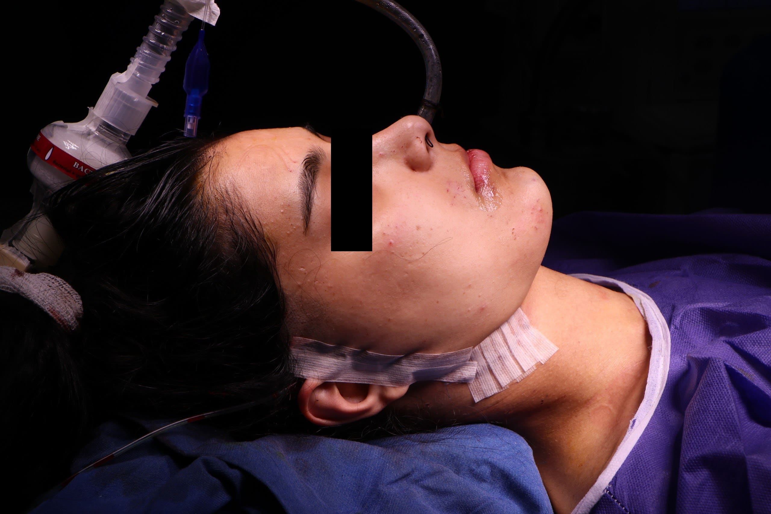 عمل تعویض مفصل فک و جراحی فک همزمان