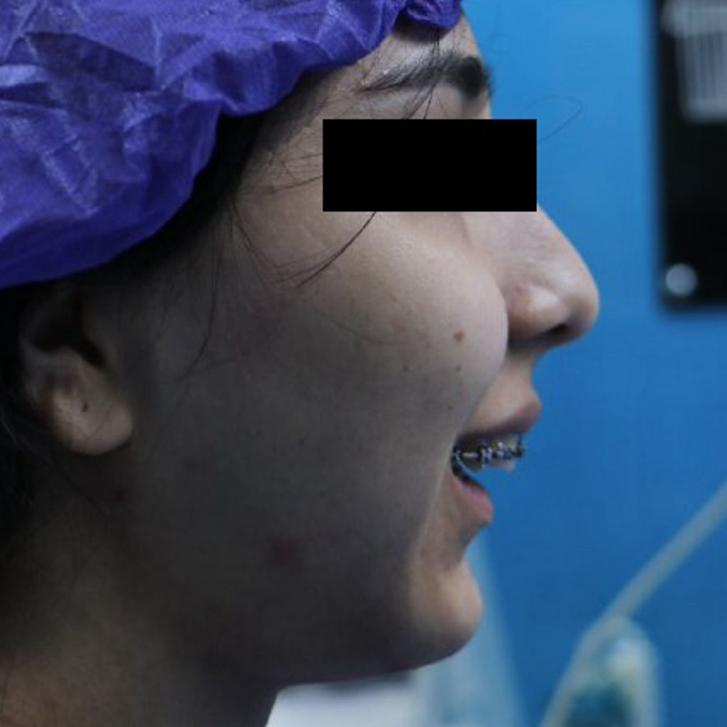 عکس قبل از عمل تعویض مفصل فک و جراحی فک همزمان