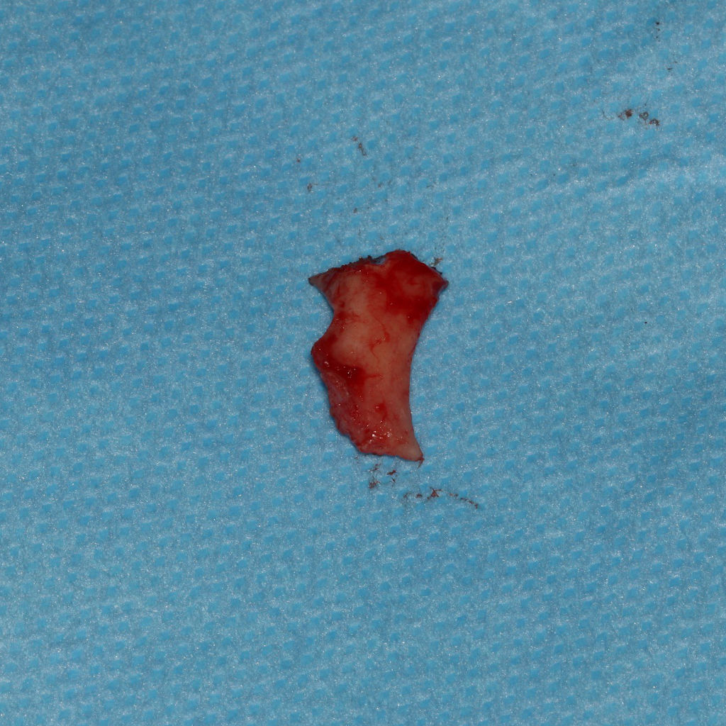 استخوان خارج شدن در جراحی همزمان تعویض مفصل فک و جراحی فک